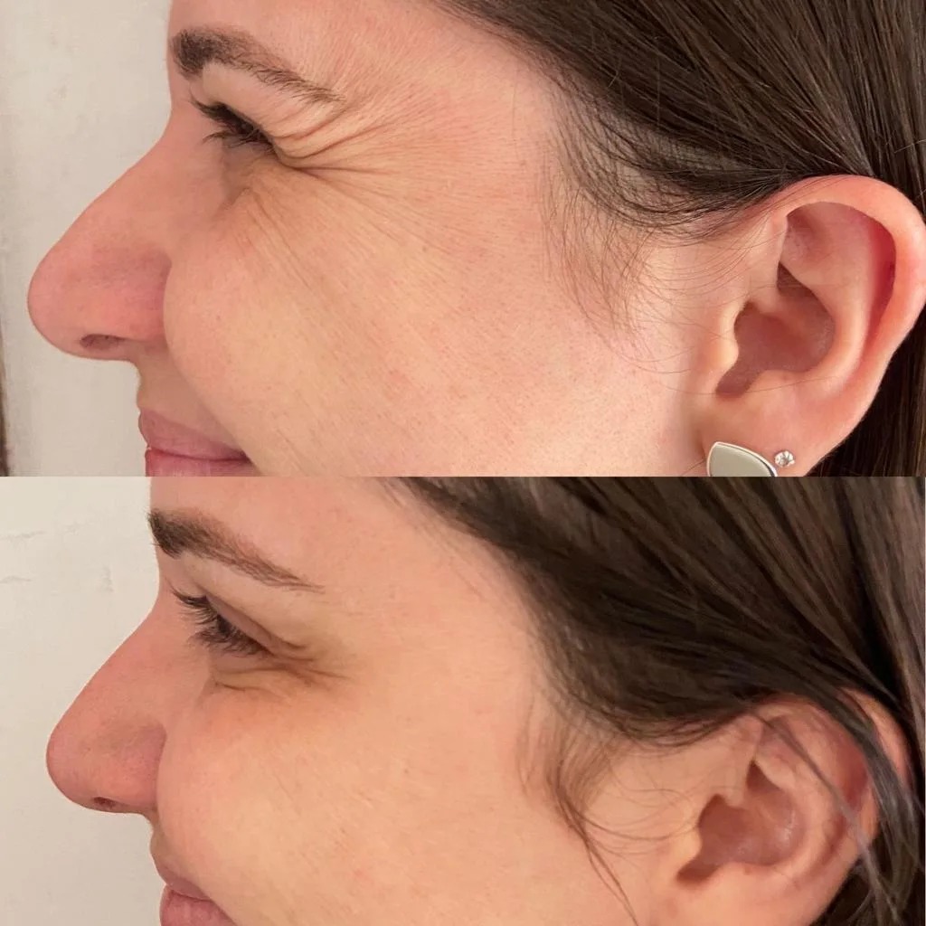 Resultado de Tratamento Estético Facial