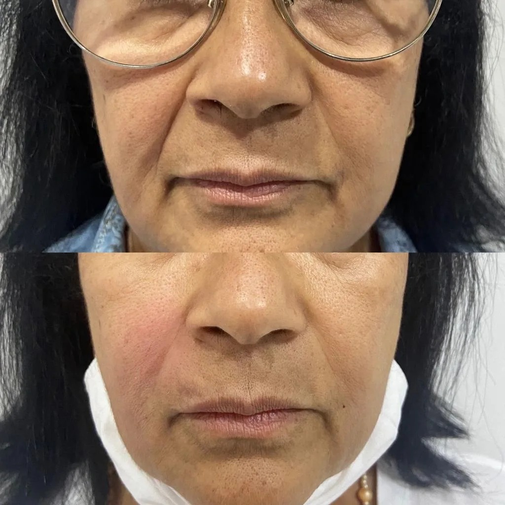Resultado de Textura Facial e Rejuvenescimento
