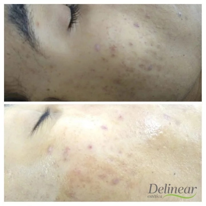 Resultado do Tratamento de Pele Profundo