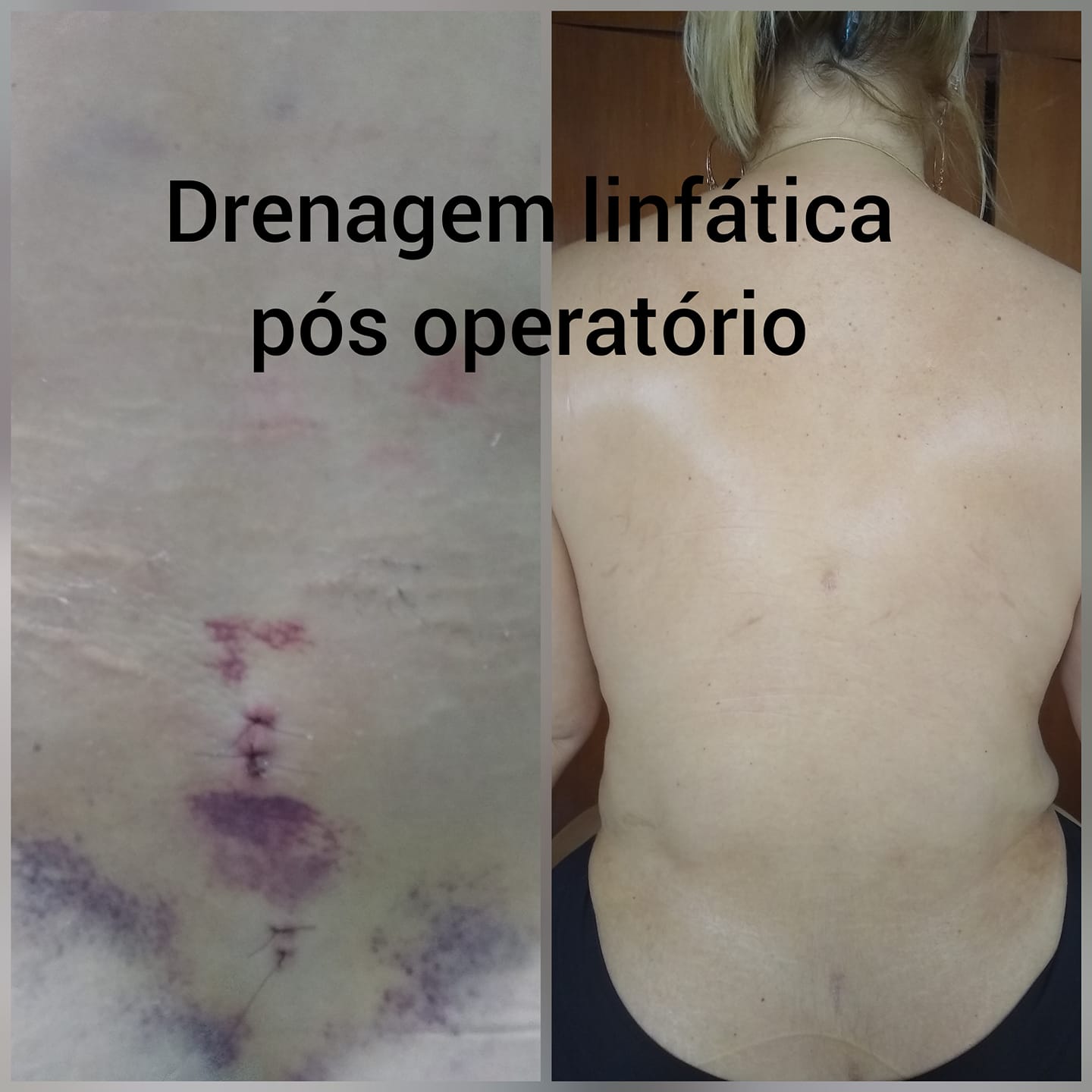 Resultado de Drenagem Pós Operatório